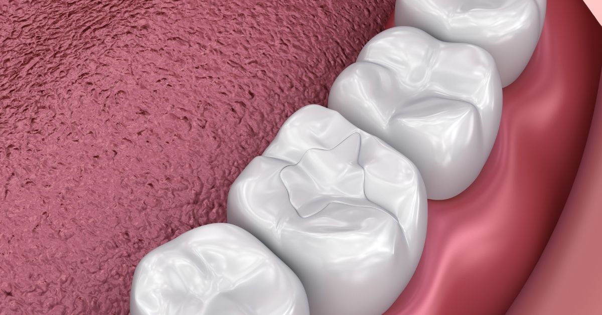 Are Dental Fillings Permanent? My Dentist