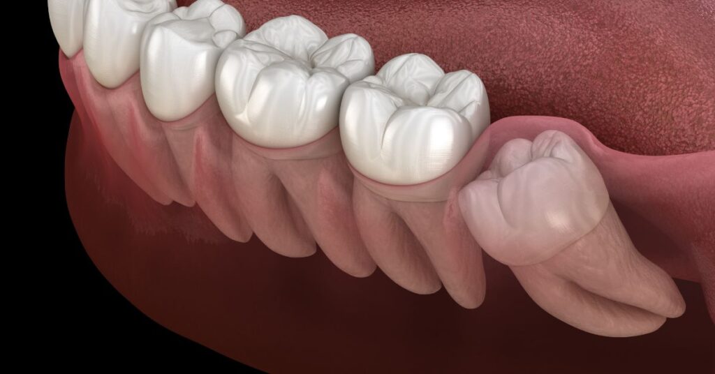 Can Wisdom Teeth Straighten Themselves Out? My Dentist